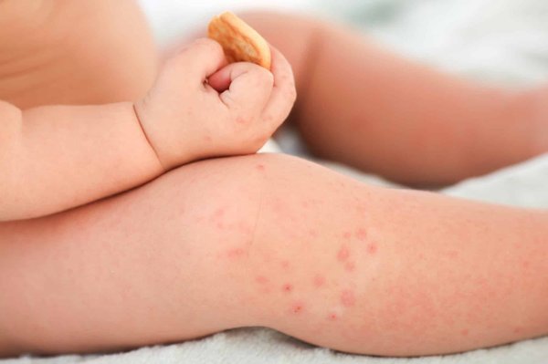 Apparitions de boutons rouges sur la peau de bébé : quelles peuvent en être les causes ?